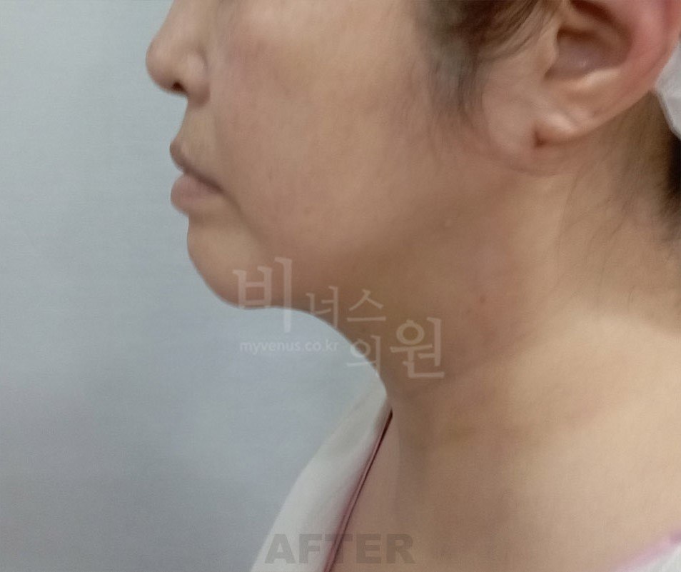 턱지방흡입 후 측면