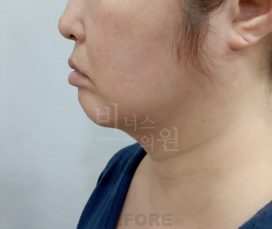 턱지방흡입 전 측면