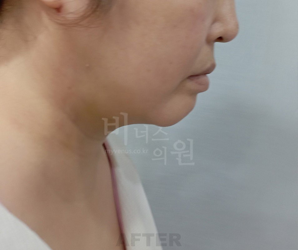 턱지방흡입 후 후면