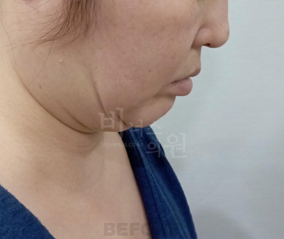 턱지방흡입 전 후면