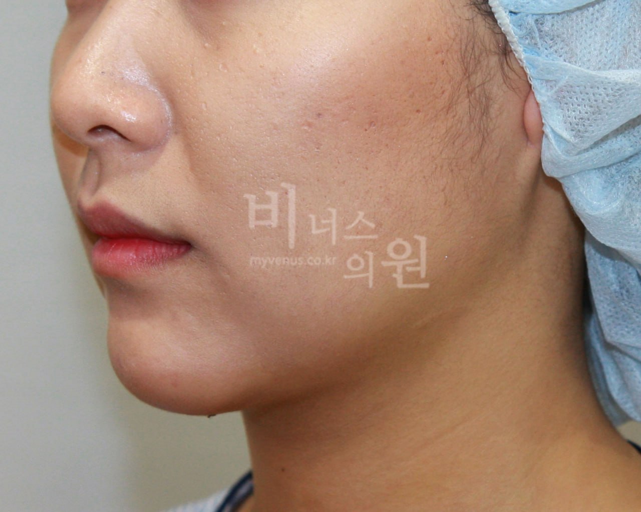 턱지방흡입 전후사진 케이스1 수술 후