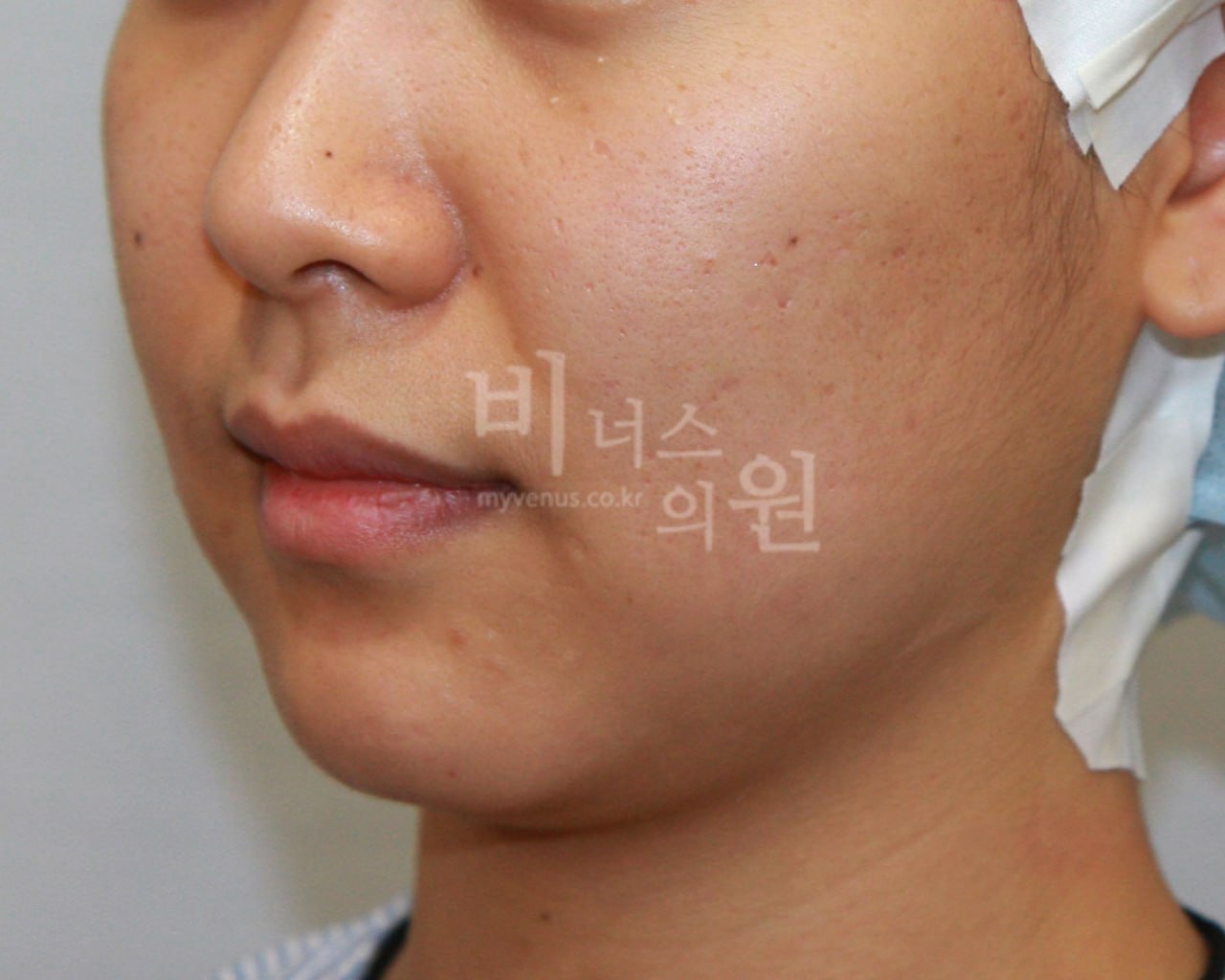턱지방흡입 전후사진 케이스1 수술 전