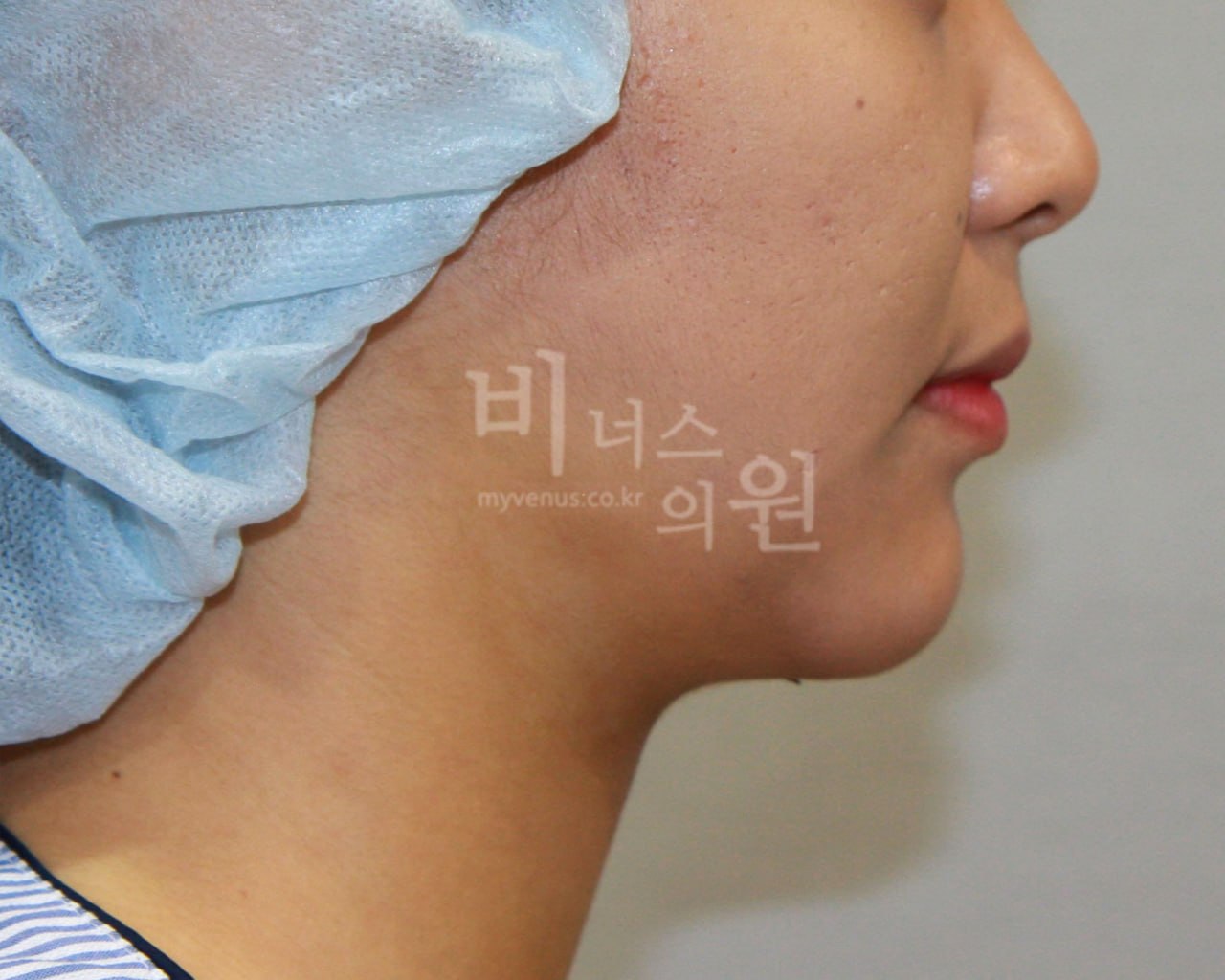 턱지방흡입 전후사진 케이스2 수술 후