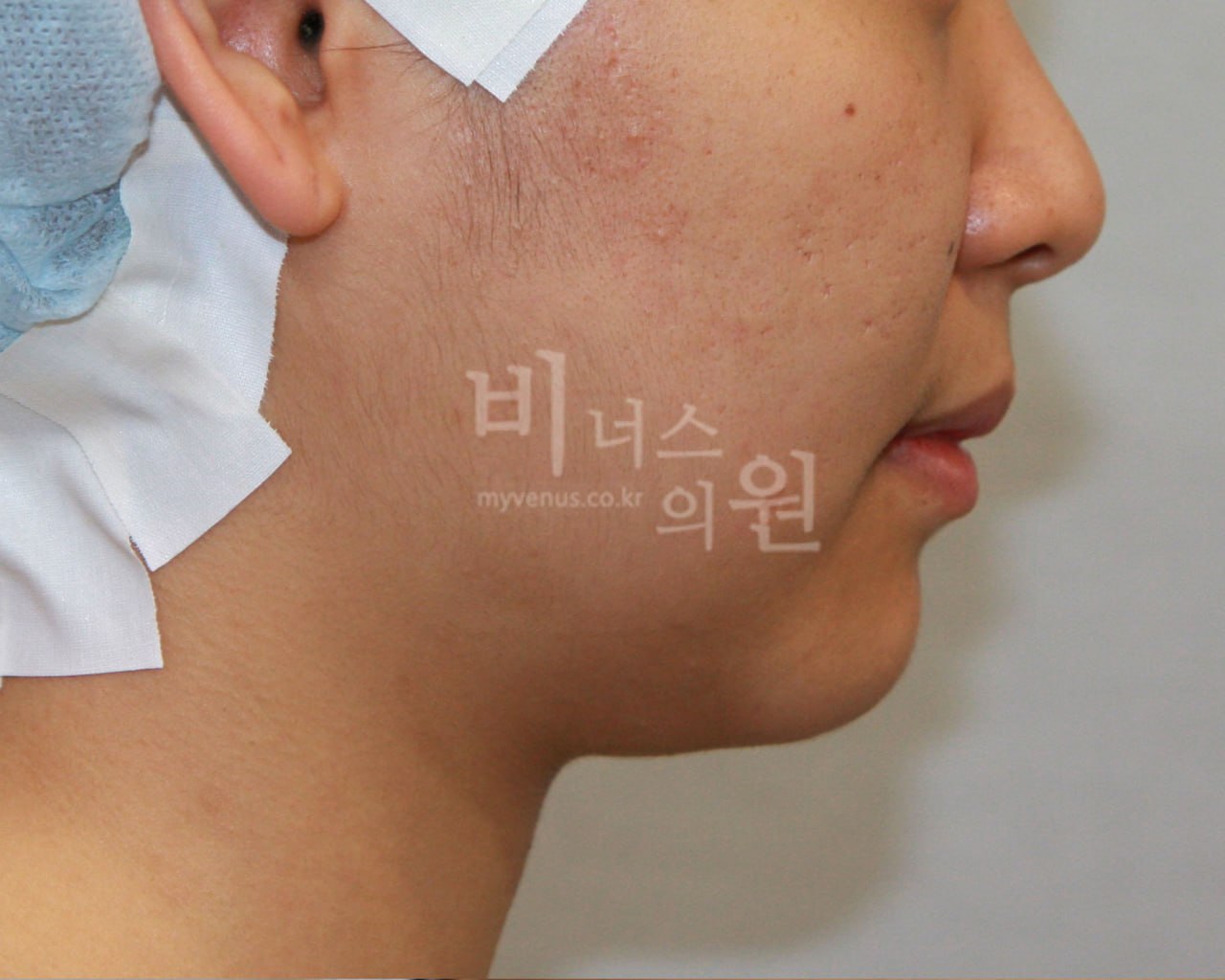 턱지방흡입 전후사진 케이스2 수술 전