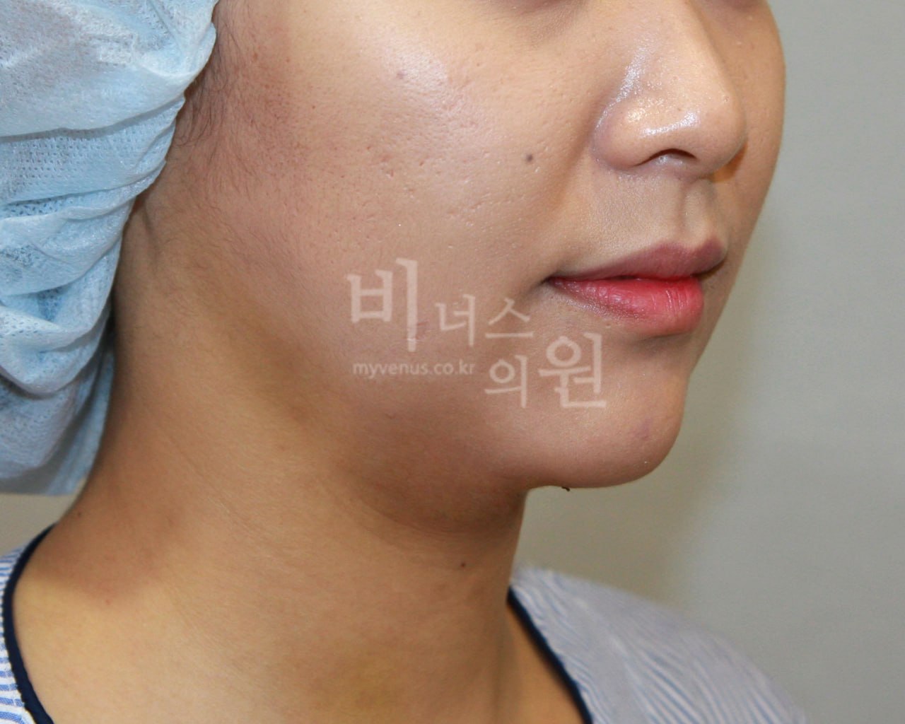 턱지방흡입 전후사진 케이스3 수술 후