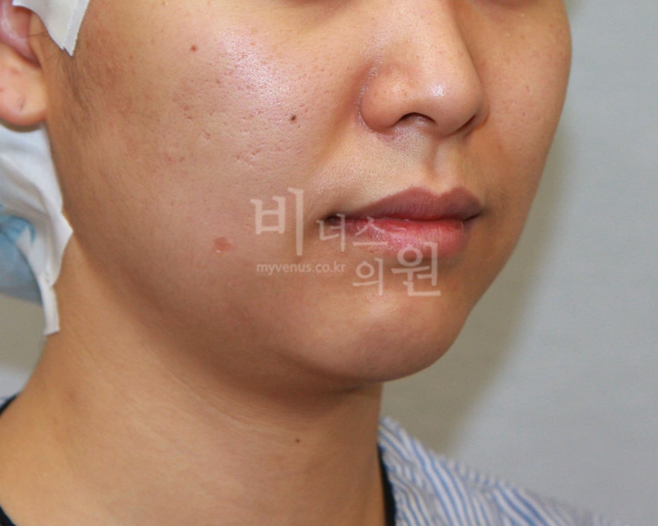 턱지방흡입 전후사진 케이스3 수술 전
