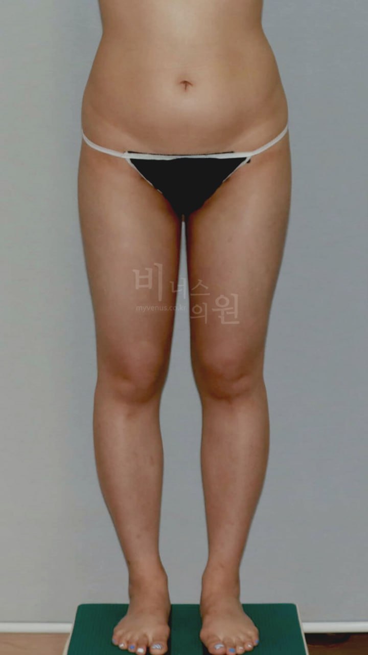 허벅지 지방흡입 비용과 선택 가이드: 수술 범위별로 다른 이유가 있어요