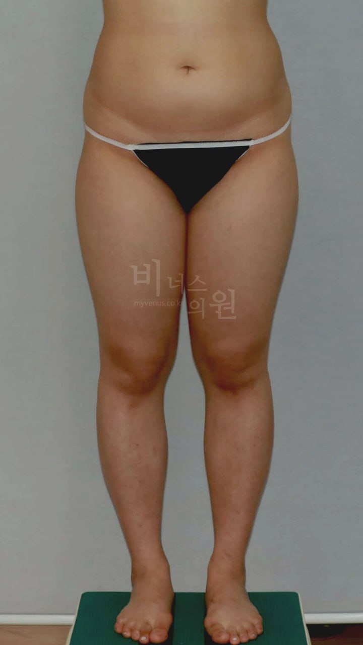허벅지 맥시머C 지방흡입 수술 전 정면