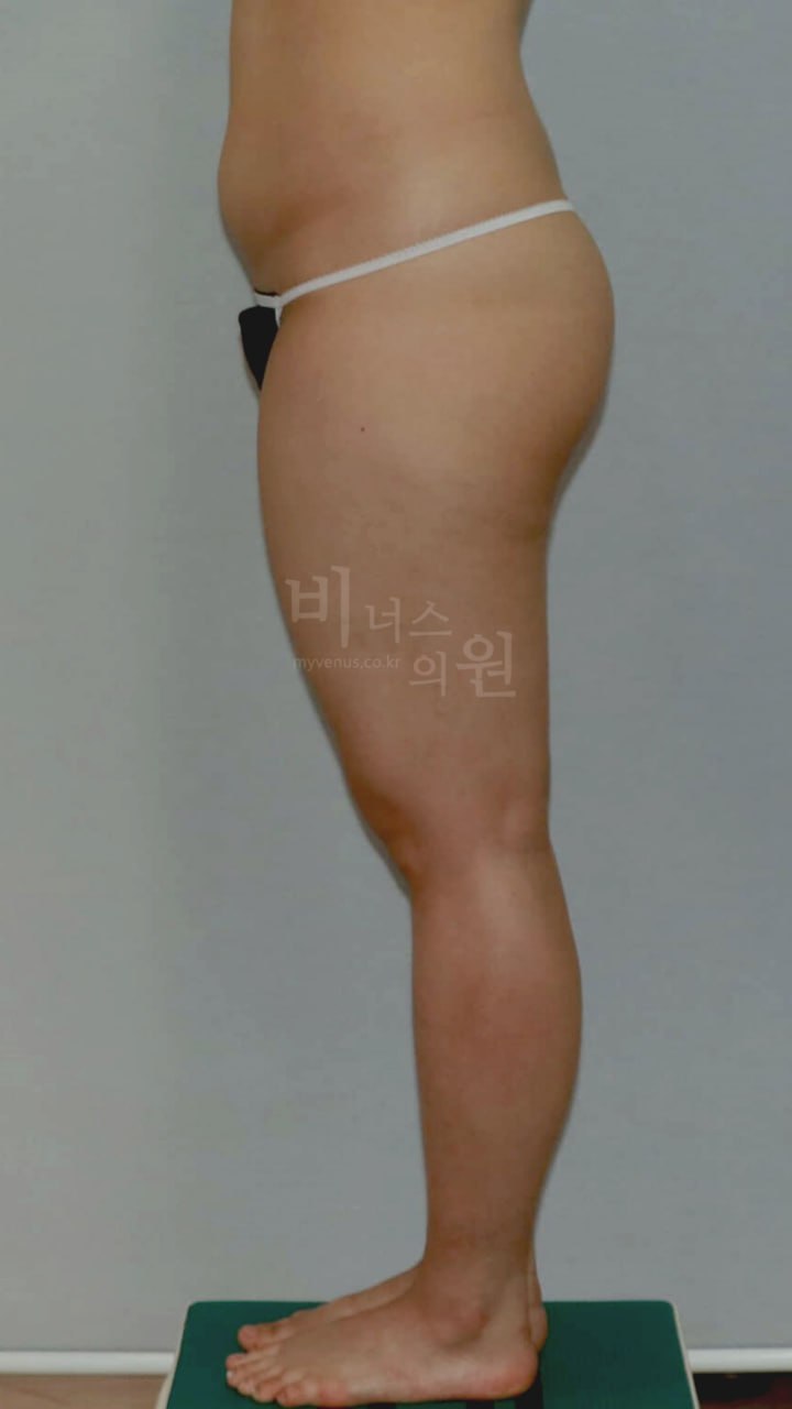 허벅지 맥시머C 지방흡입 수술 전 측면