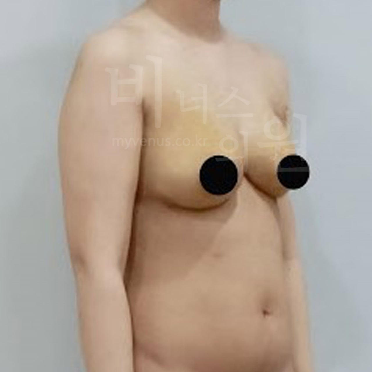 가슴축소 전후사진 2 - 수술 후