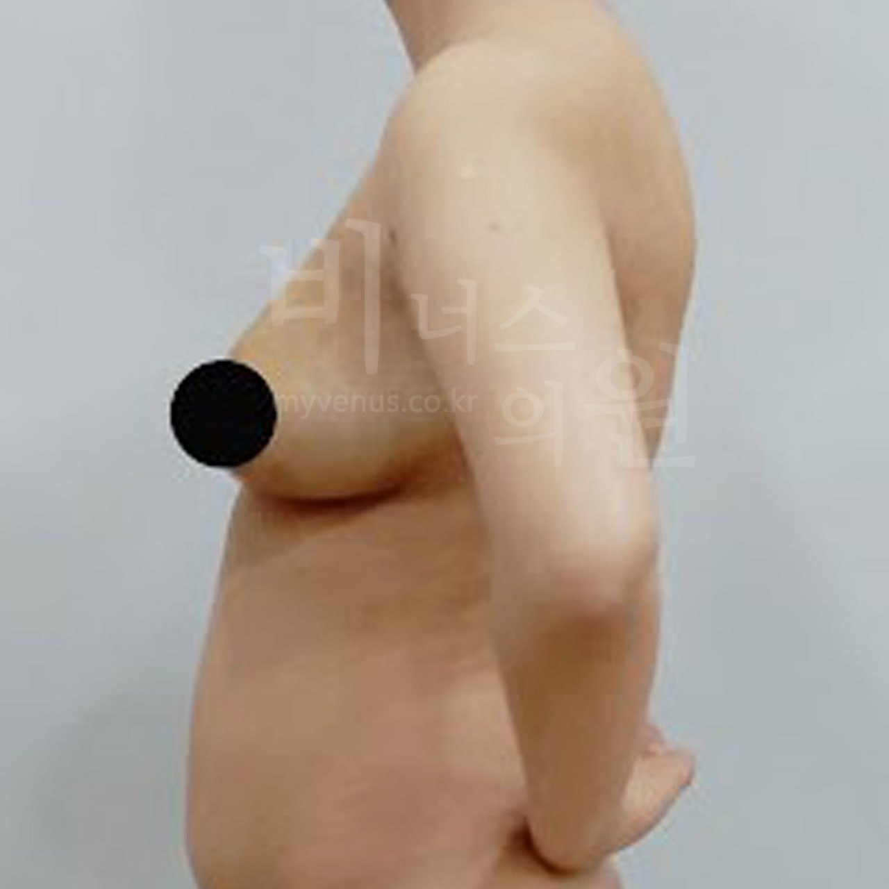 가슴축소 전후사진 3 - 수술 전