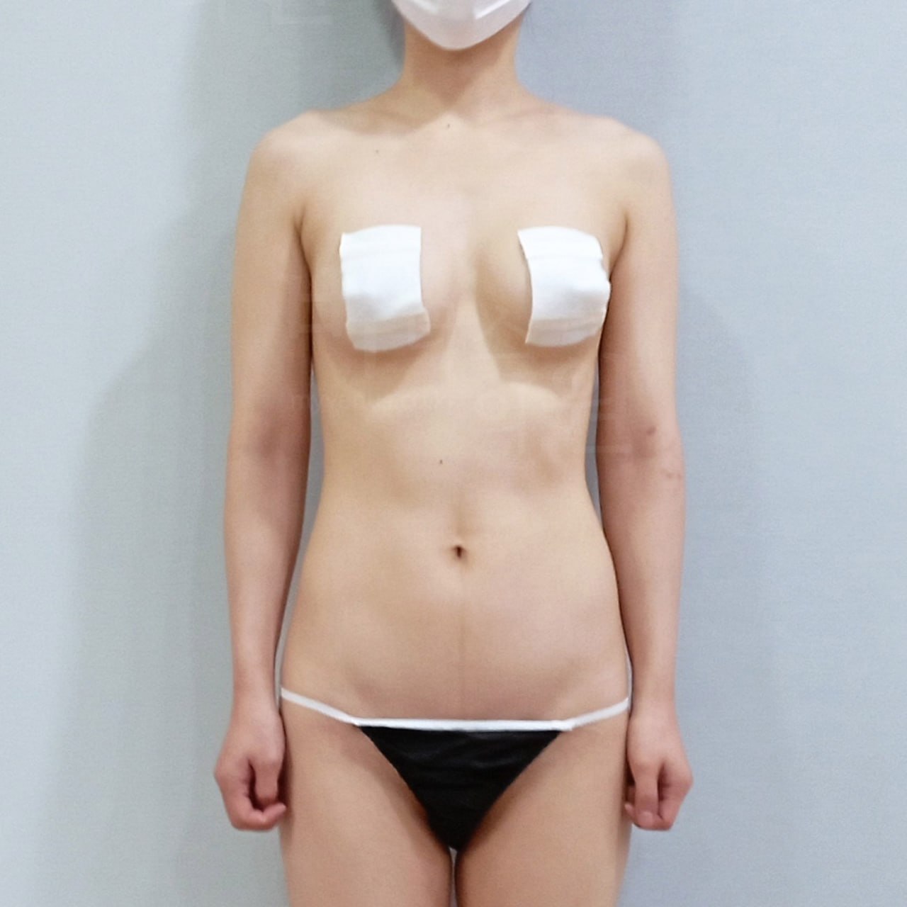 팔뚝 대용량 지방흡입 수술 전 정면