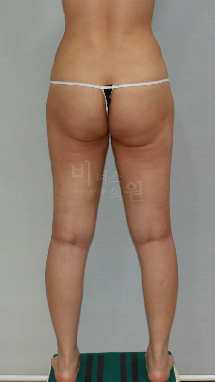 엉덩이 볼륨업 지방흡입 수술 전