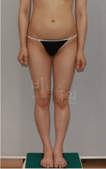 엉덩이 지방흡입 종류별 비교 — 축소·볼륨업·힙업 중 내 체형엔 뭐가 맞을까?