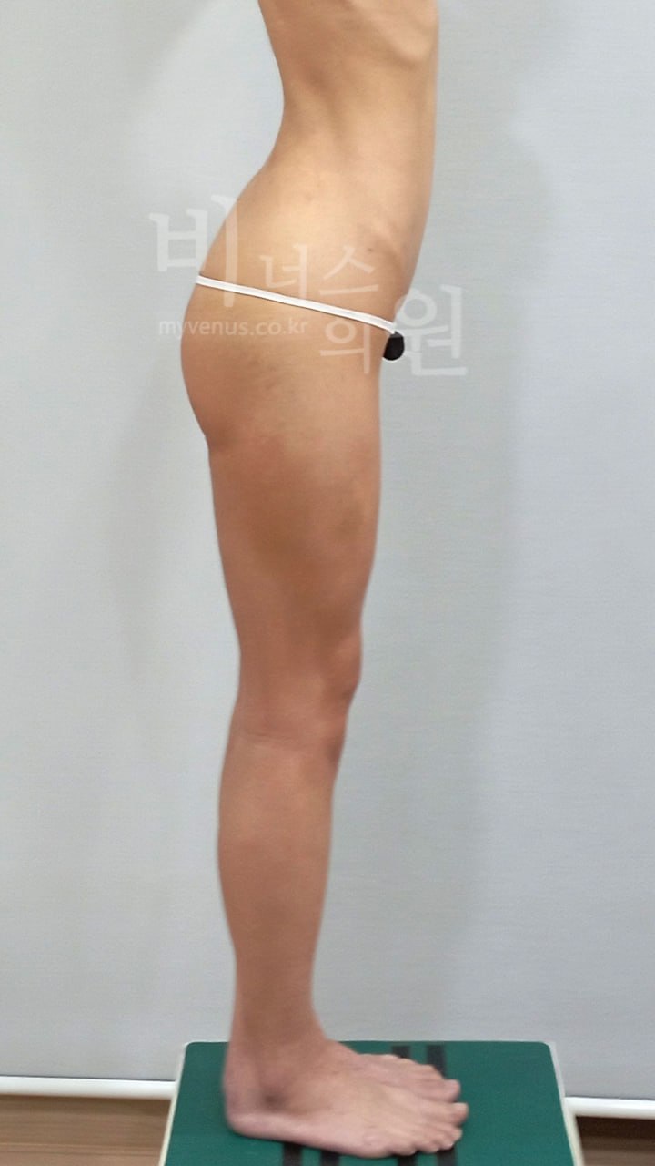 수술 후