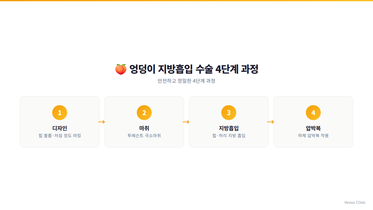 엉덩이 지방흡입 수술 4단계 과정 인포그래픽
