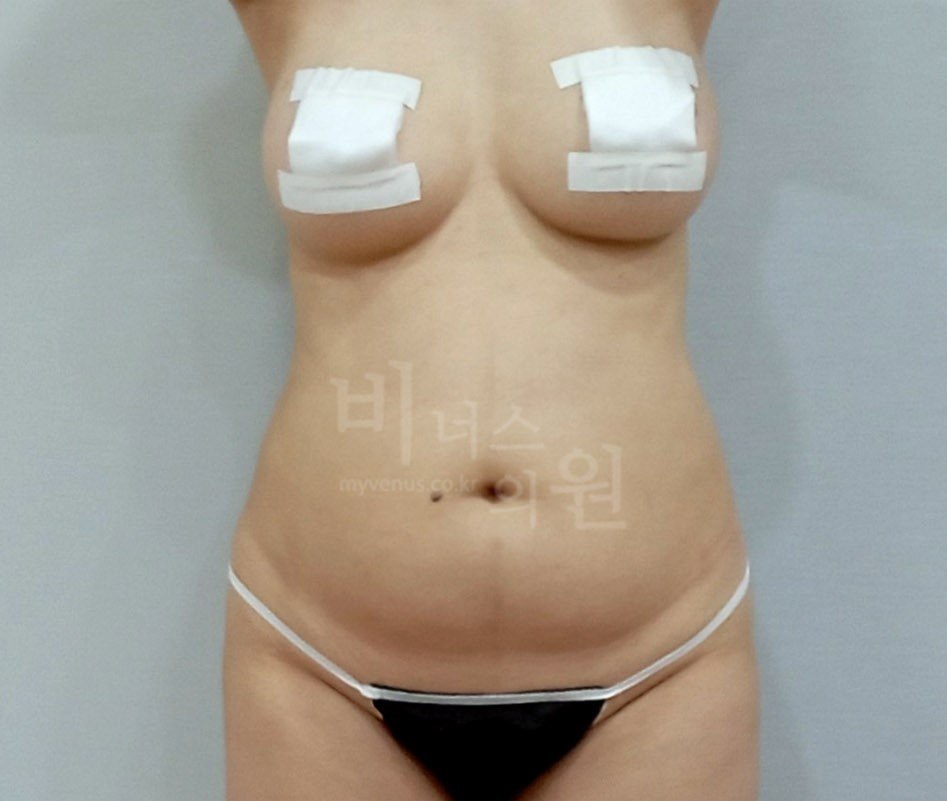 원통형 흉복부 지방흡입 재수술 — 복부 정면 수술 전