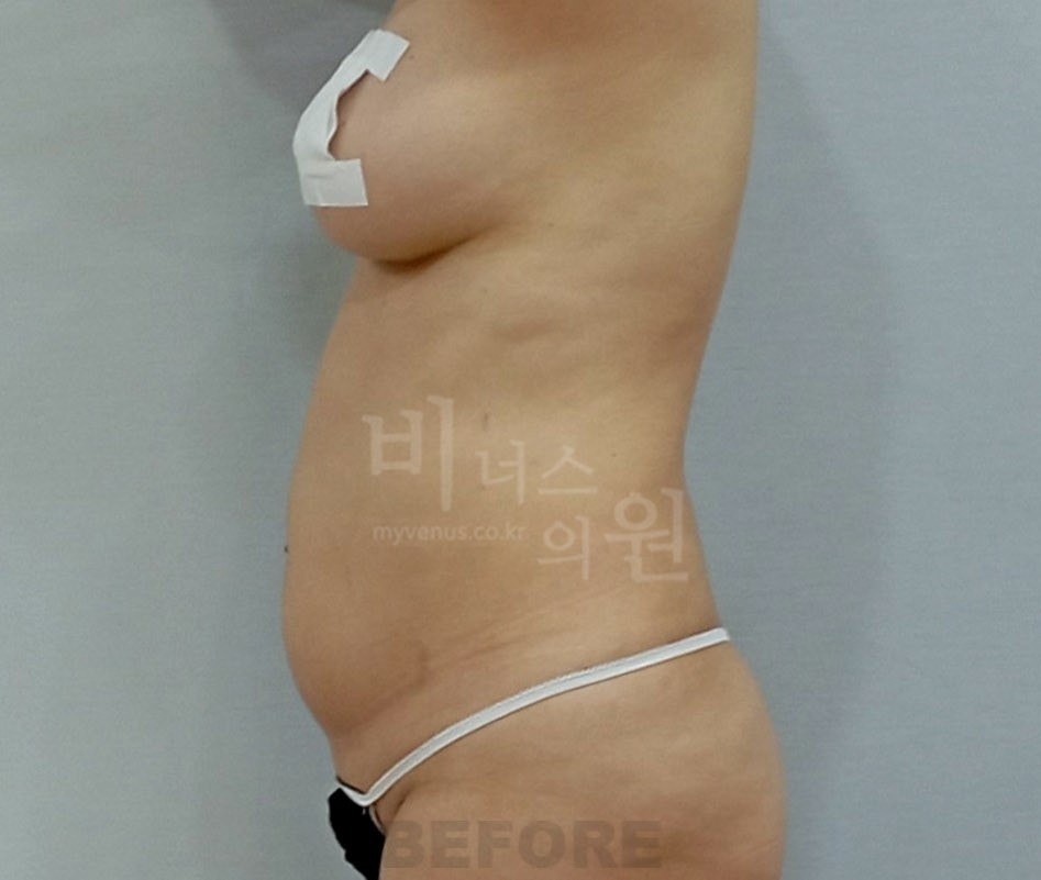 흉복부 지방흡입 재수술 — 복부 측면 수술 전