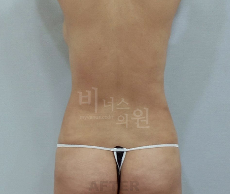 흉복부 지방흡입 재수술 — 등 후면 수술 후