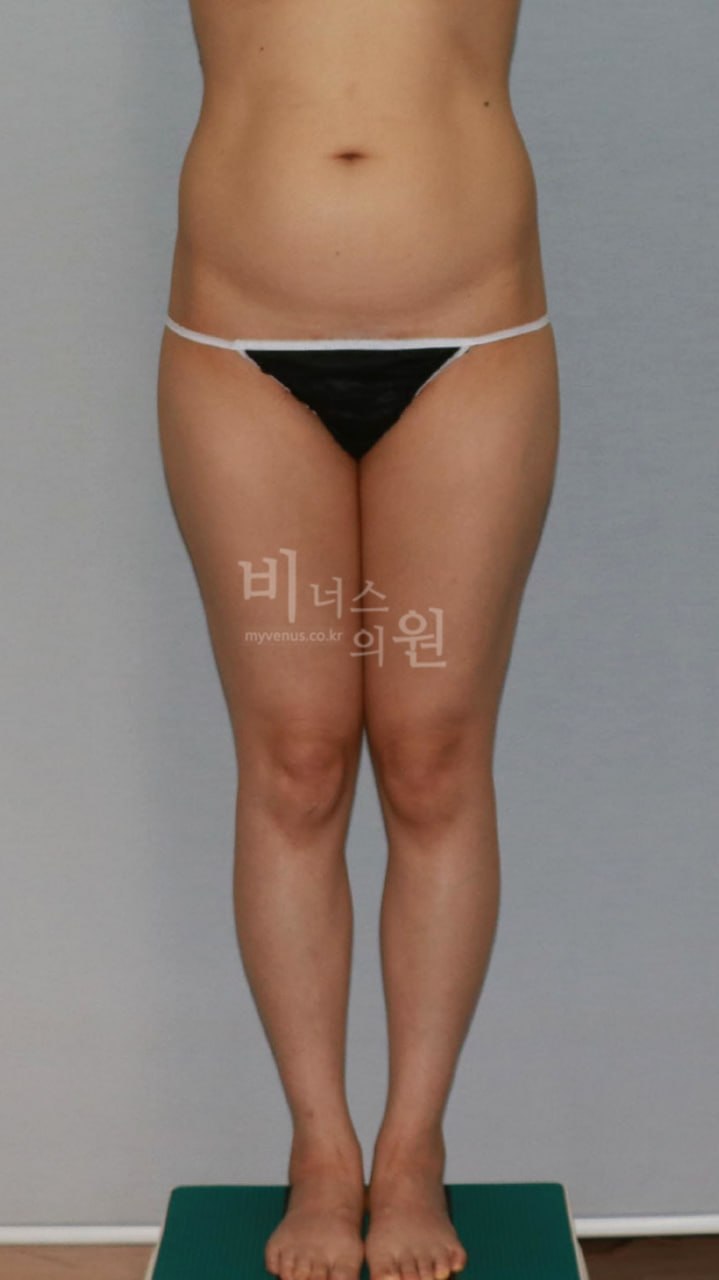 엉덩이 복부 지방흡입 수술 전 정면