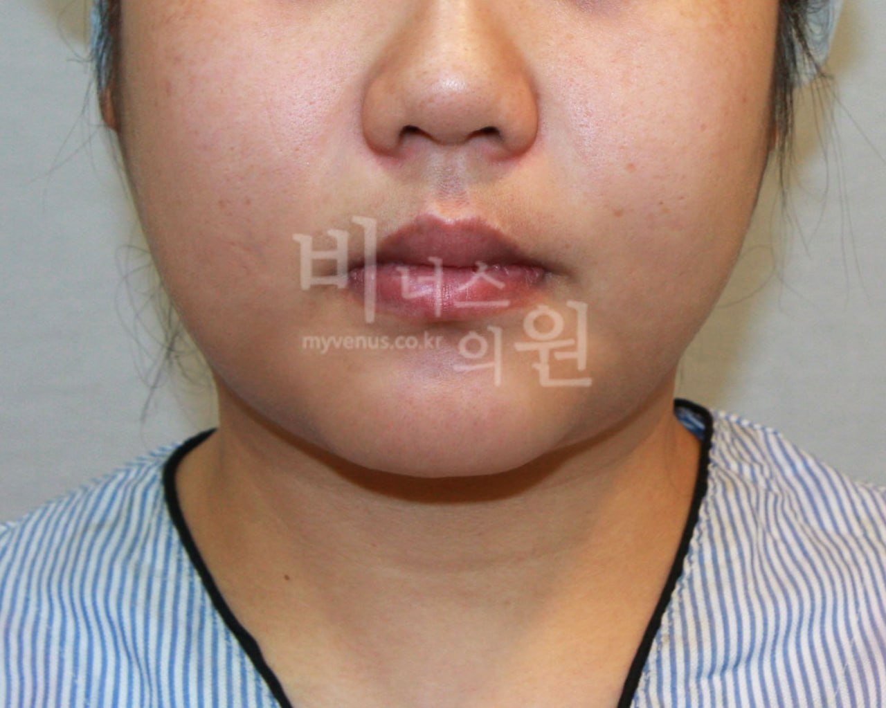 이중턱 턱지방흡입 수술 전 비너스의원