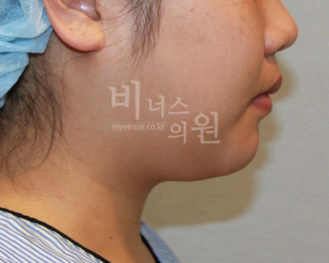 이중턱 턱지방흡입 수술 전 비너스의원