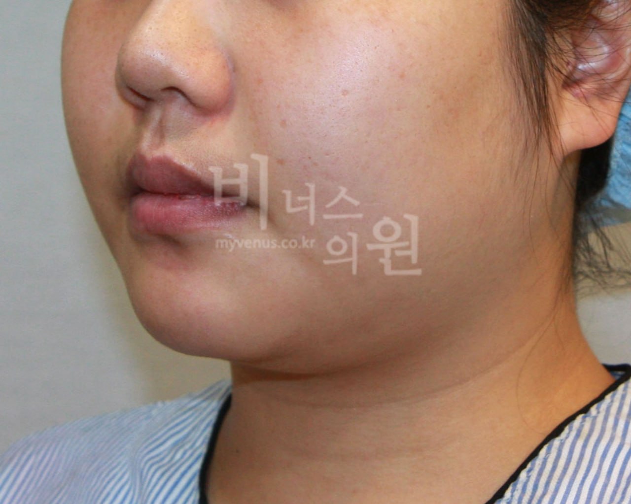이중턱 턱지방흡입 수술 전 비너스의원