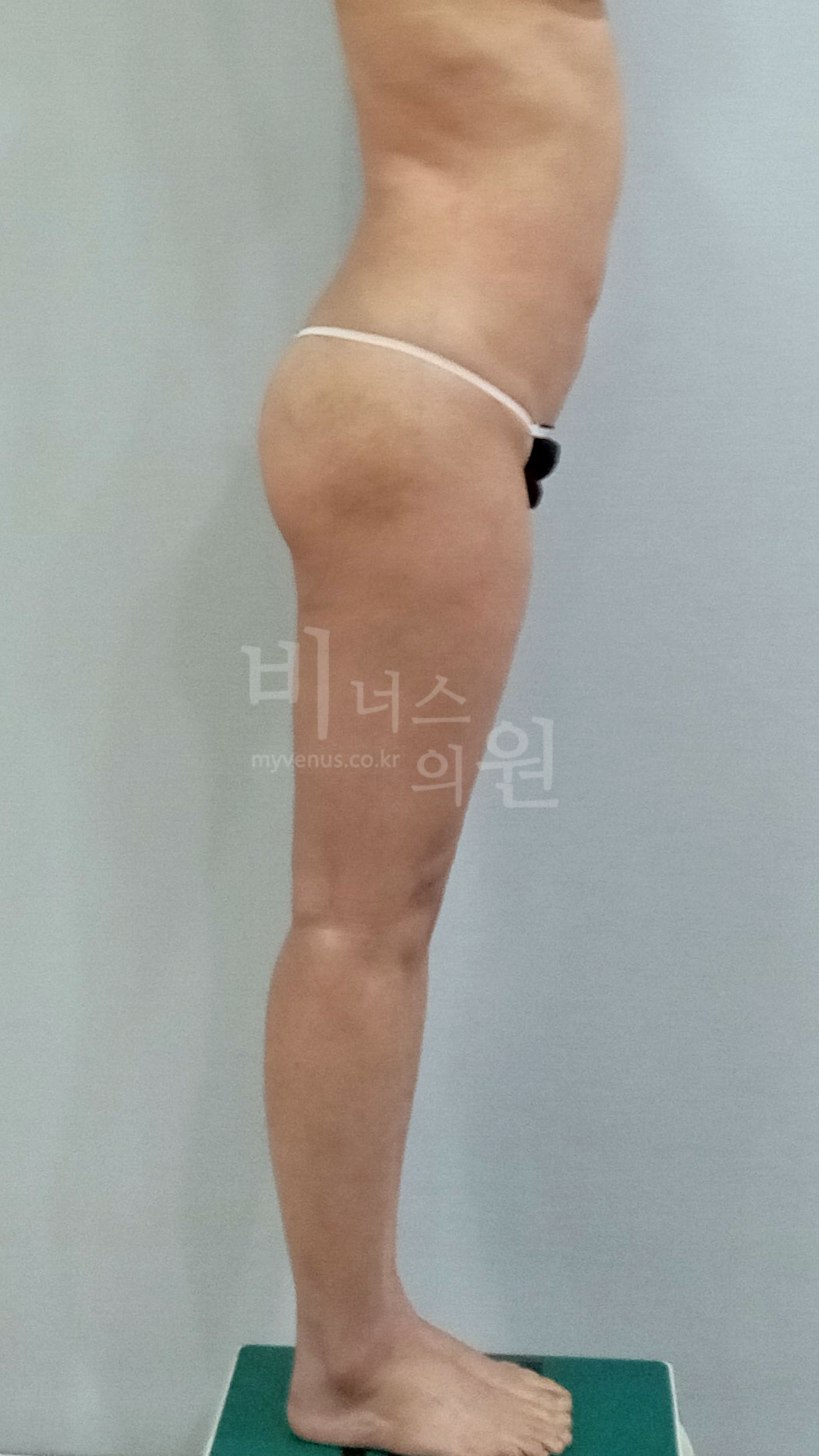복부 엉덩이 볼륨업 지방흡입 수술 후 측면 — 비너스의원