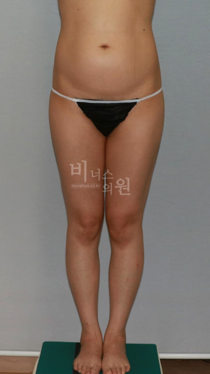 엉덩이축소 수술 비용, 어떻게 결정될까요? — 수술법 선택부터 병원 고르는 법까지