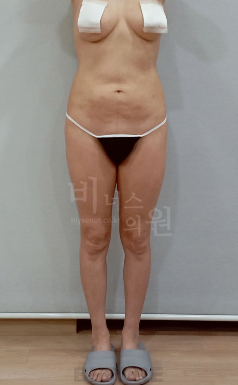 엉덩이 지방흡입 수술 전