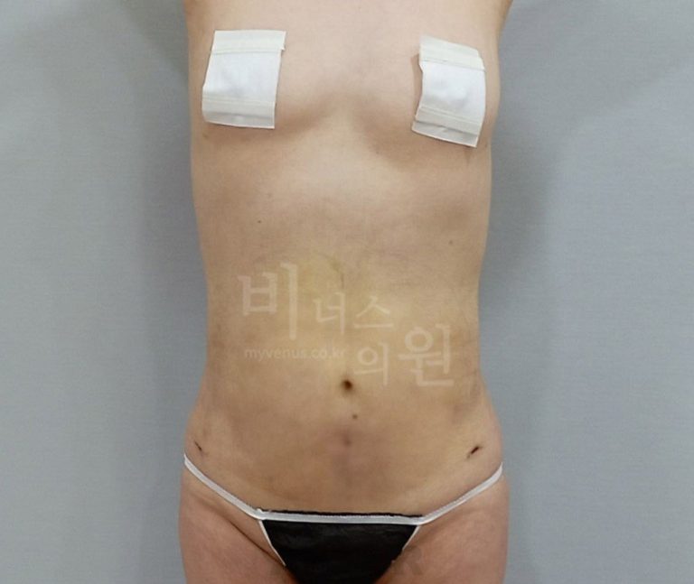 복부 지방흡입, 범위별 비용과 선택 기준 완전 정리 — 부천 비너스의원