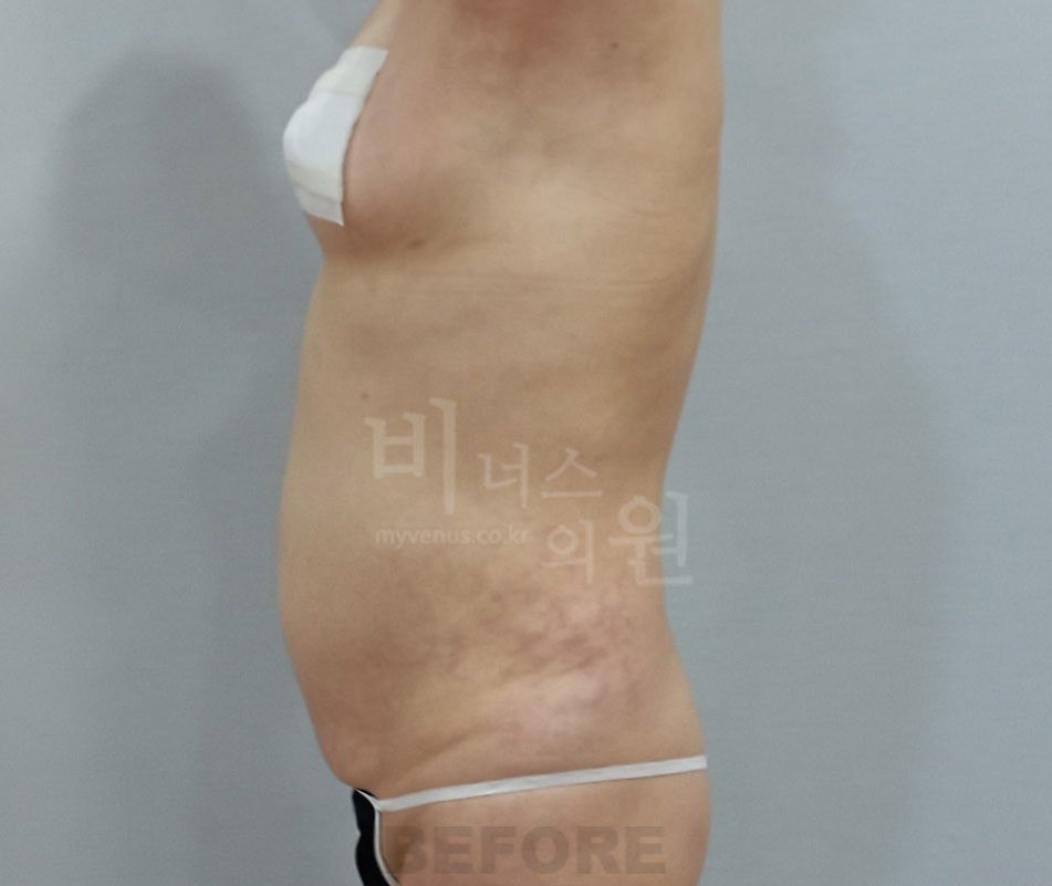 수술 전 사례 3