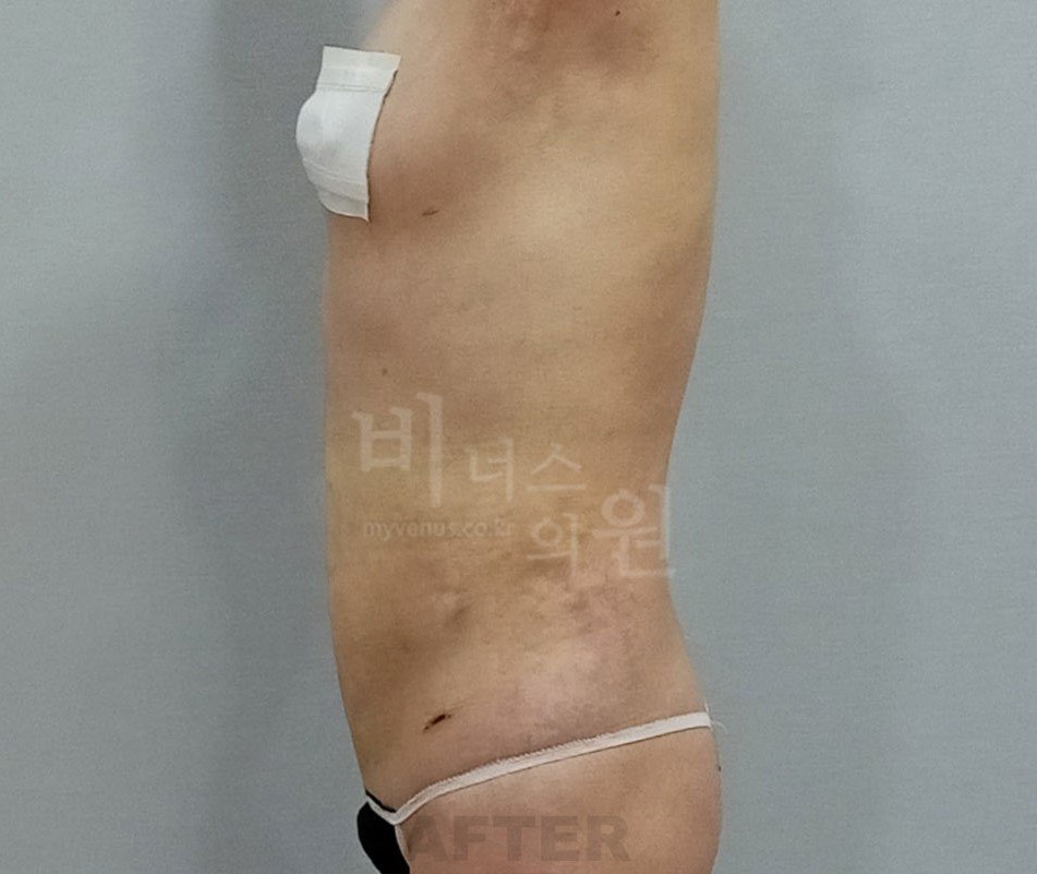 수술 후 사례 3