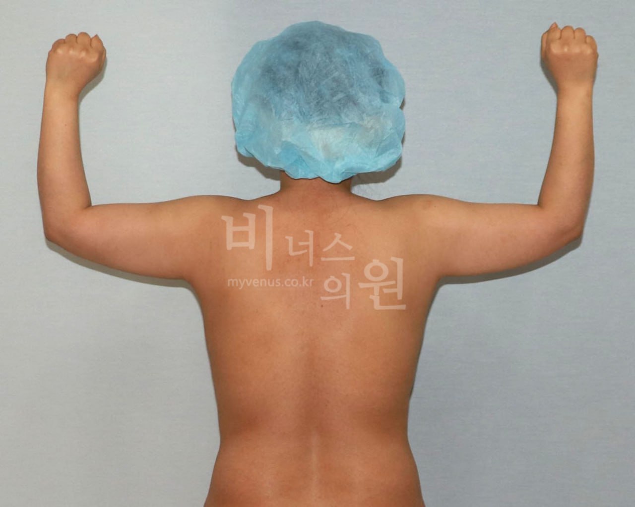 팔뚝 대용량 지방흡입 수술 전