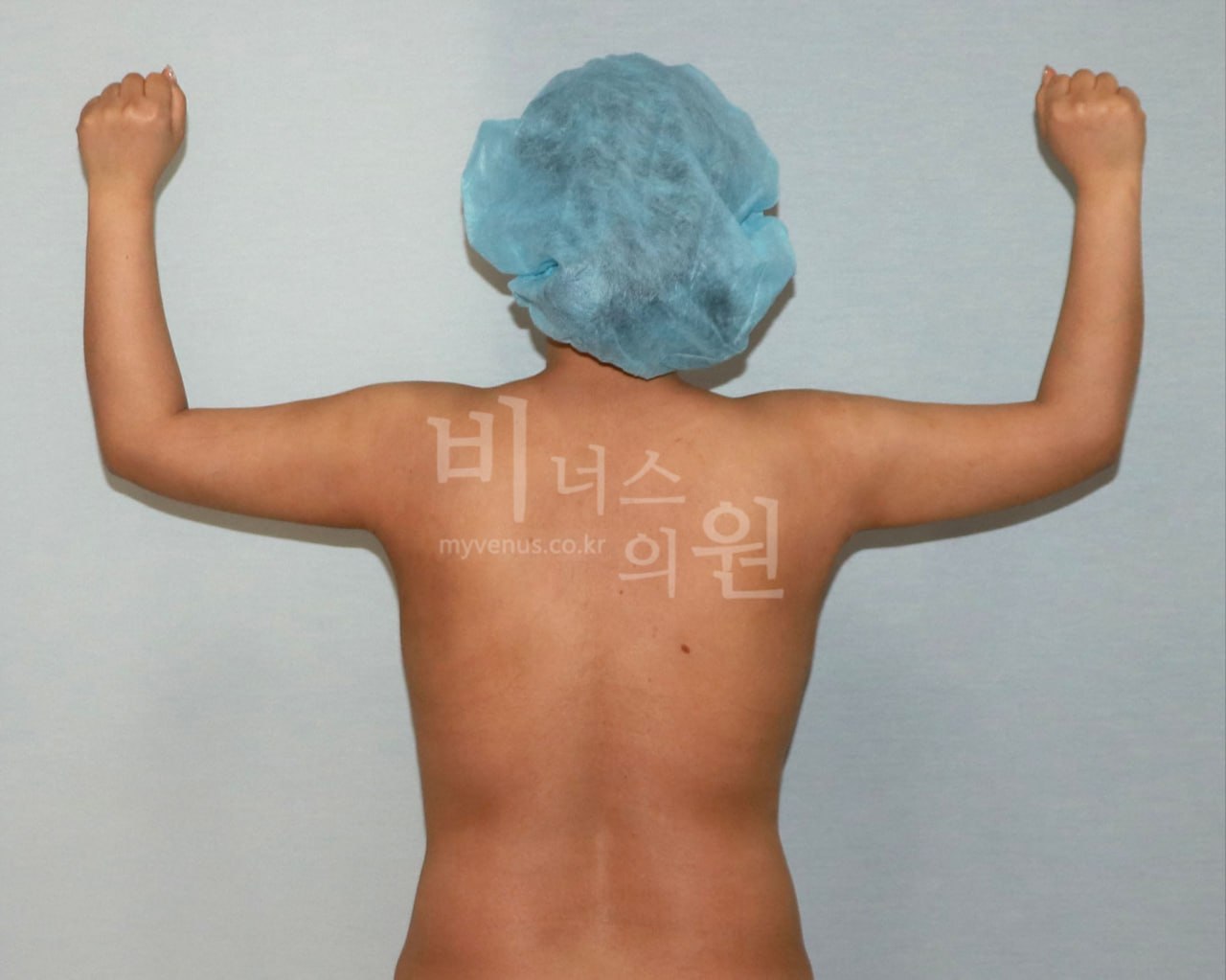 팔뚝 대용량 지방흡입 수술 후