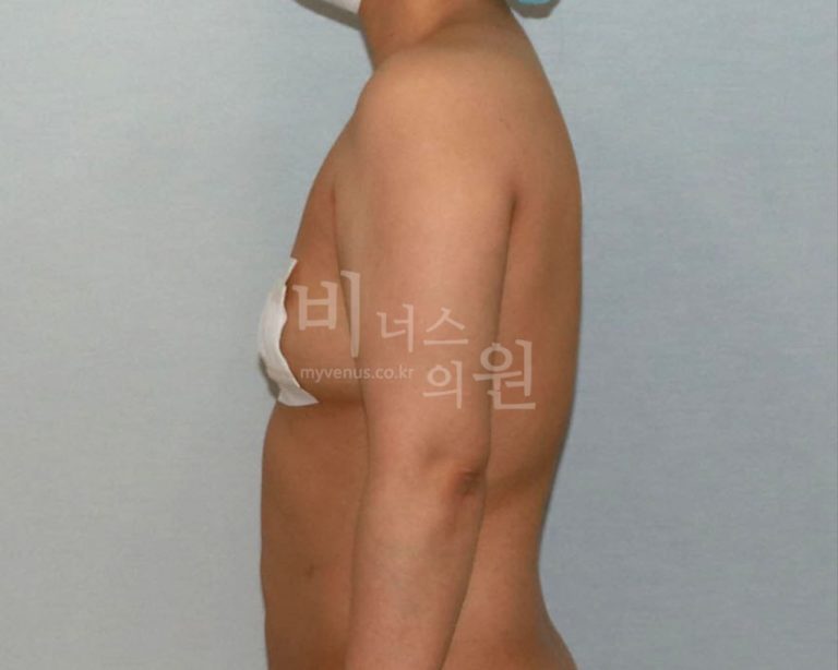 팔뚝지방흡입 비용, 어디서 차이가 날까? 후회 없는 선택을 위한 실전 가이드