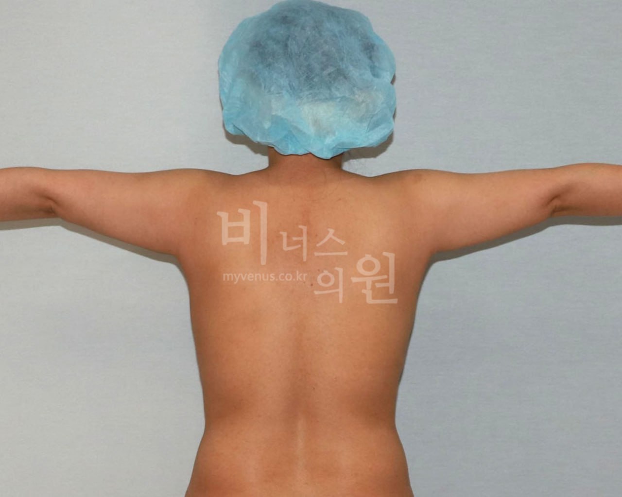 팔뚝 대용량 지방흡입 수술 전