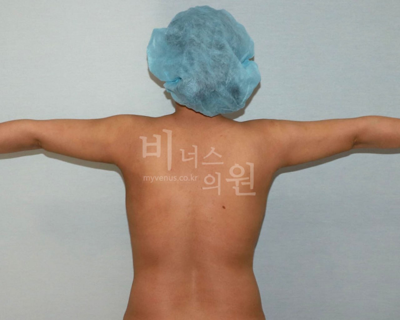 팔뚝 대용량 지방흡입 수술 후