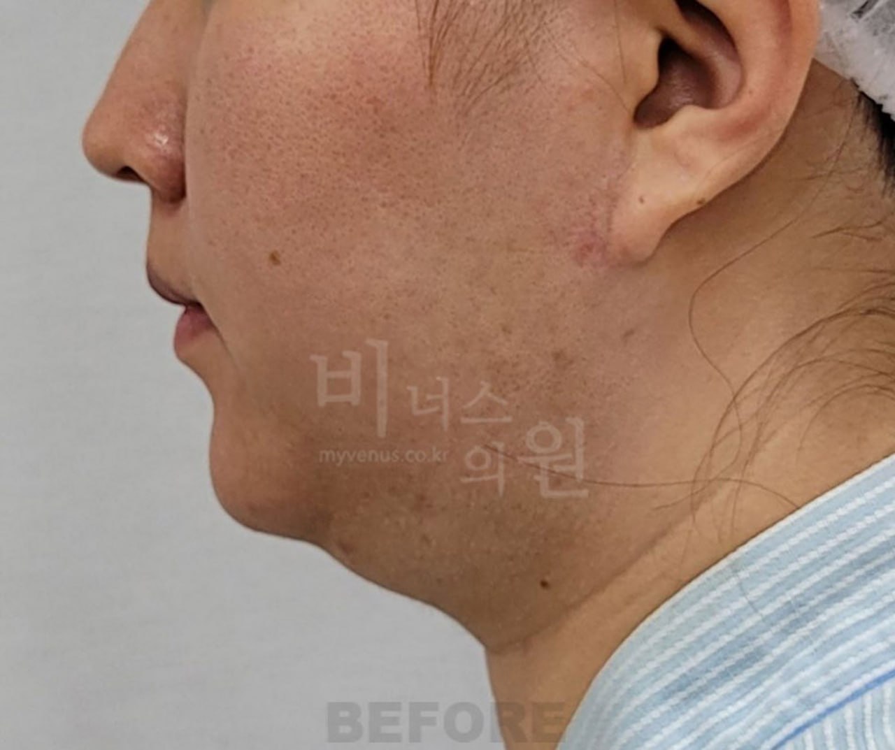 턱지방흡입 수술 전 사례 2 비너스의원