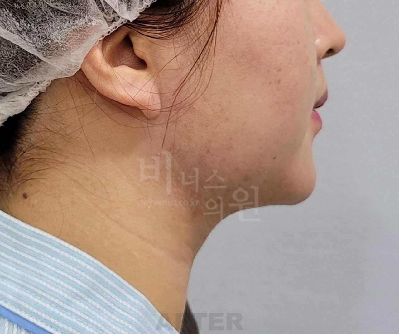 턱지방흡입 수술 후 사례 3 비너스의원