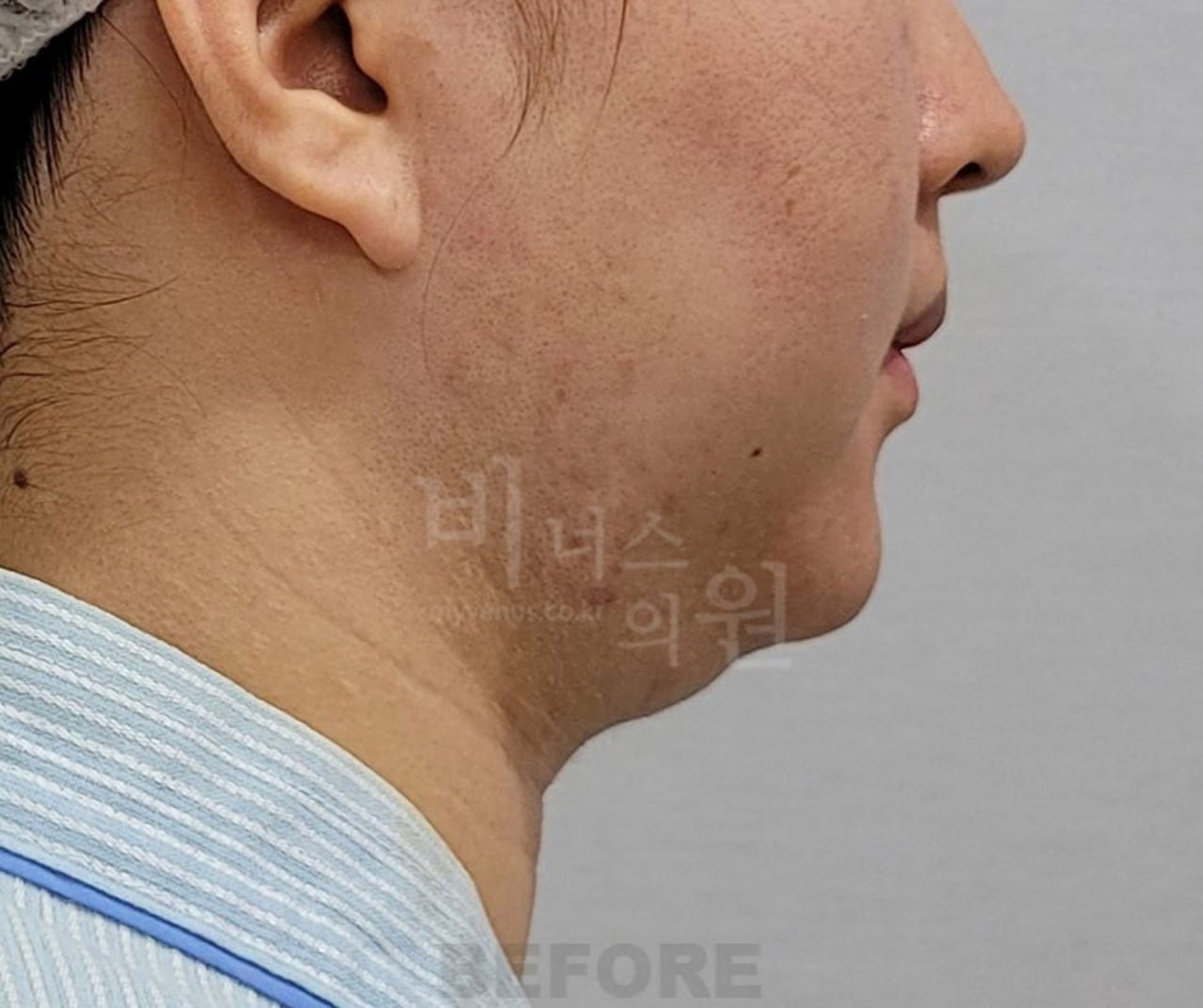 턱지방흡입 수술 전 사례 3 비너스의원