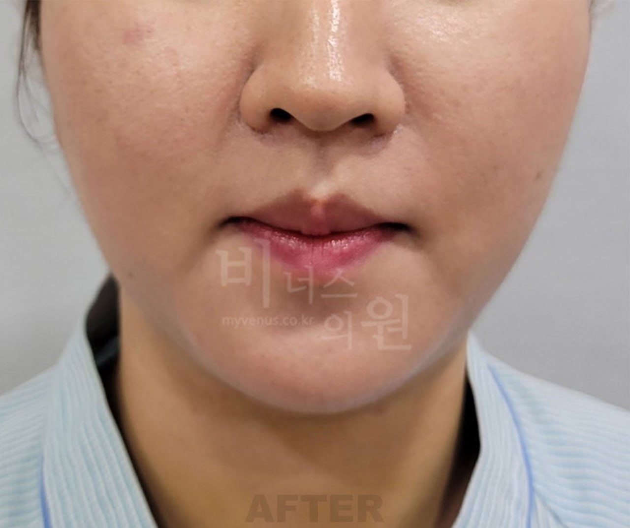 턱지방흡입 수술 후 사례 1 비너스의원