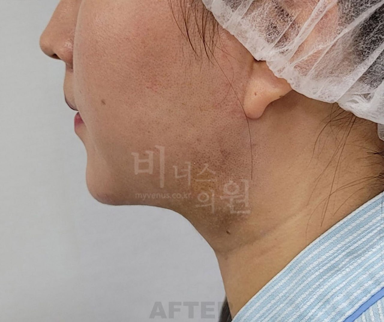 턱지방흡입 수술 후 사례 2 비너스의원