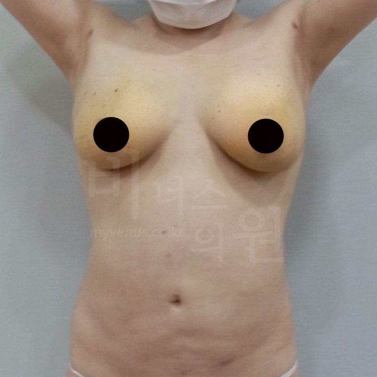 가슴이 무거워 운동도 힘드세요? 가슴축소 지방흡입 비용·장점·회복 정리