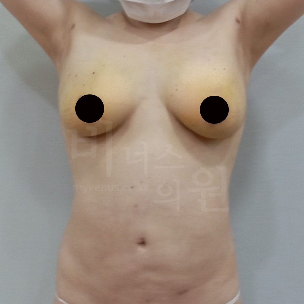 가슴축소 지방흡입 수술 후 정면