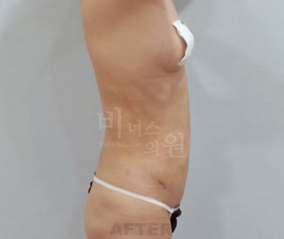 원통형 흉복부 지방흡입 재수술 후 — 측면 비너스의원