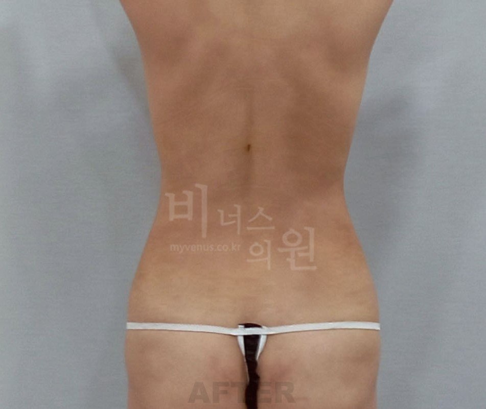 원통형 흉복부 지방흡입 재수술 후 — 후면 비너스의원