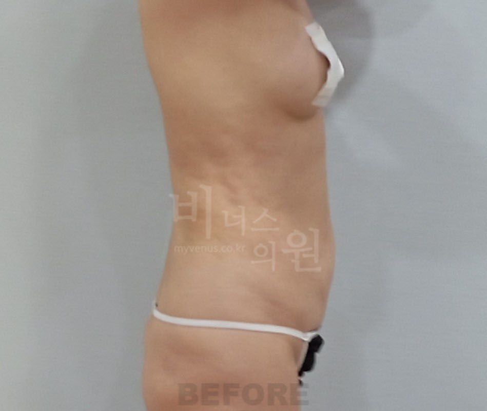 원통형 흉복부 지방흡입 재수술 전 — 측면 비너스의원