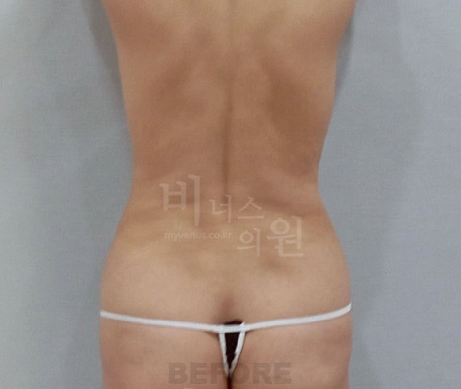 원통형 흉복부 지방흡입 재수술 전 — 후면 비너스의원