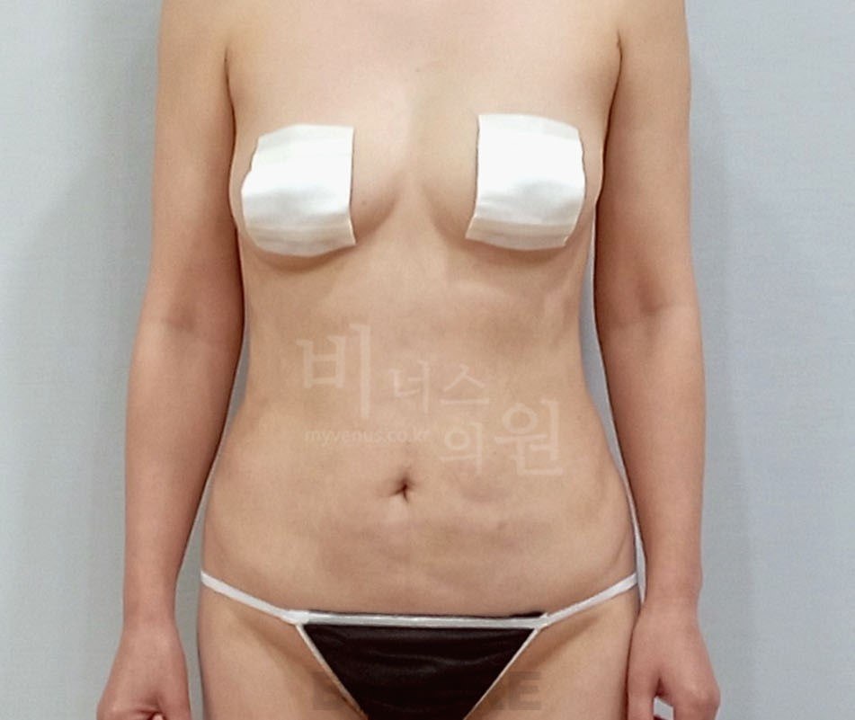 원통형 흉복부 지방흡입 재수술 전 — 정면 비너스의원